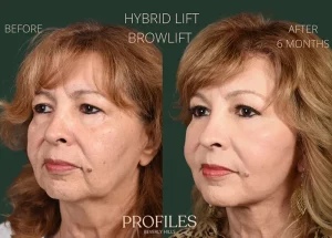 hybrid-facelift-results-300x215