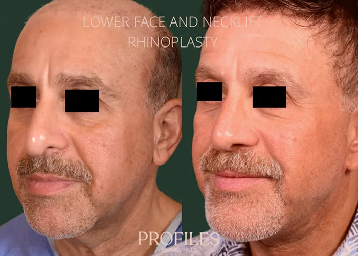 redefining-masculine-rejuvenation-male-rhinoplasty