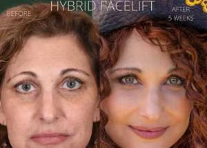 what-makes-our-signature-hybrid-facelift-unique-300x215