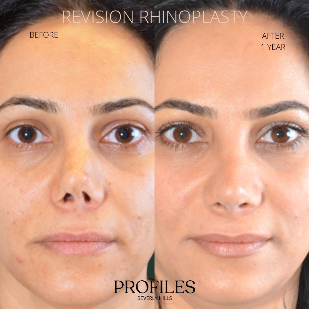 revision-rhinoplasty-pat-1
