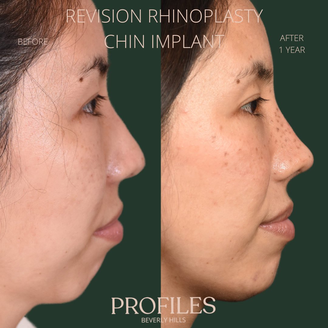 revision-rhinoplasty-pat-2