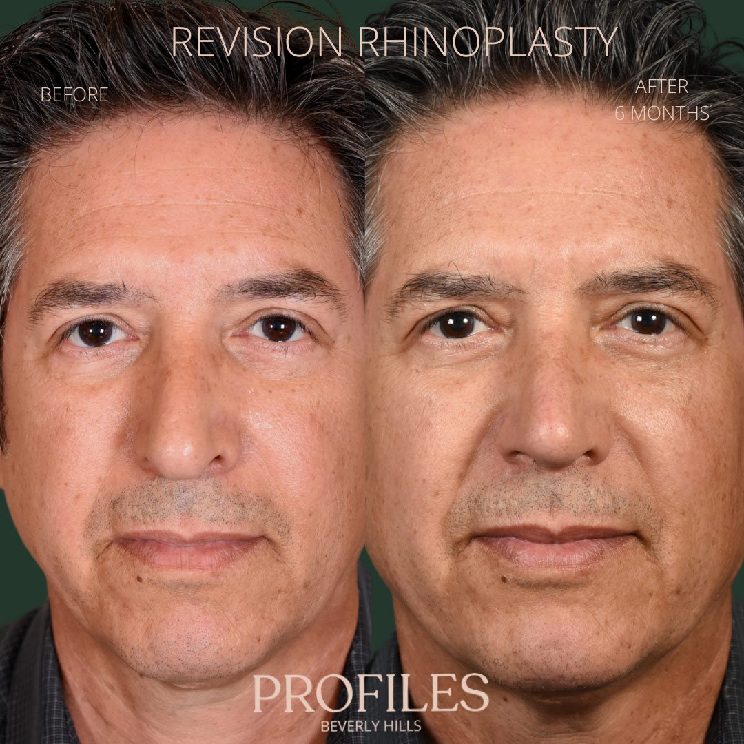 revision-rhinoplasty-pat-3