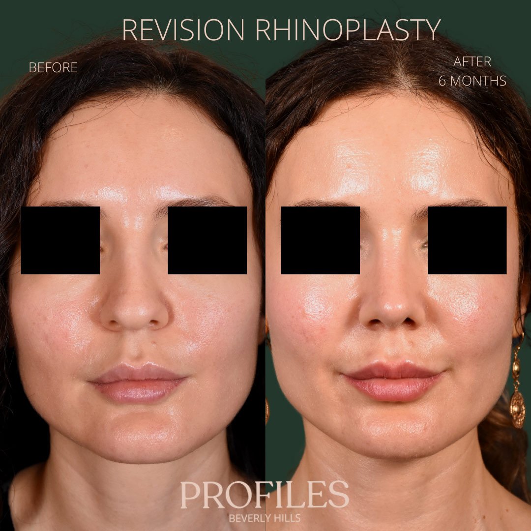 revision-rhinoplasty-pat-4